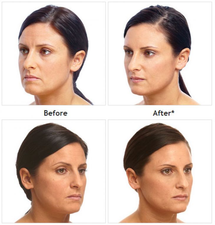 Juvéderm before and after treatment