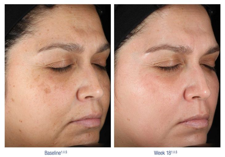 Nu Derm Before and After