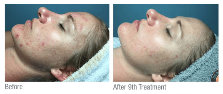 Celluma Acne treatment