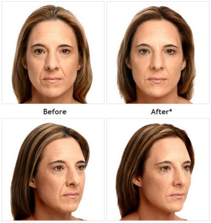 Juvéderm before and after treatment