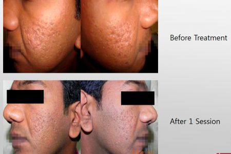Infini-Before-After-43.jpg