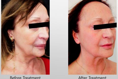 Infini-Before-After-10.jpg