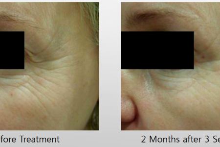 Infini-Before-After-3.jpg