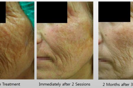 Infini-Before-After-1.jpg