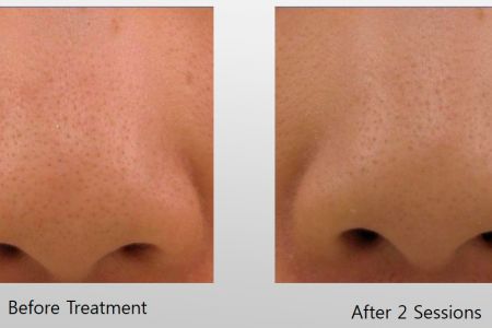 Infini-Before-After-18.jpg
