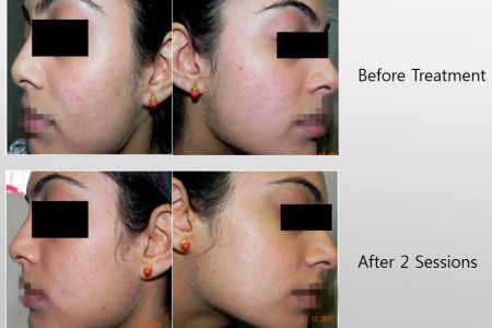 Infini-Before-After-42.jpg