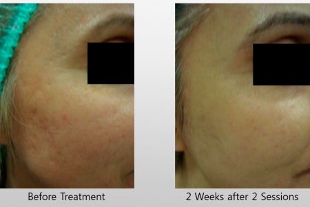 Infini-Before-After-28.jpg