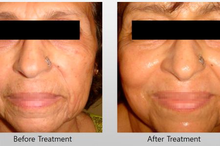 Infini-Before-After-8.jpg