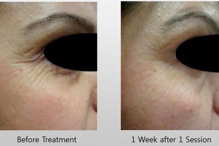 Infini-Before-After-6.jpg