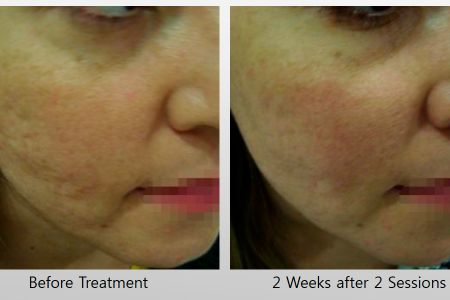 Infini-Before-After-26.jpg