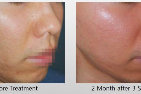 Infini-Before-After-29.jpg