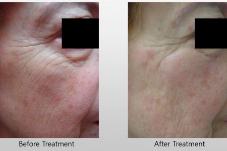 Infini-Before-After-11.jpg